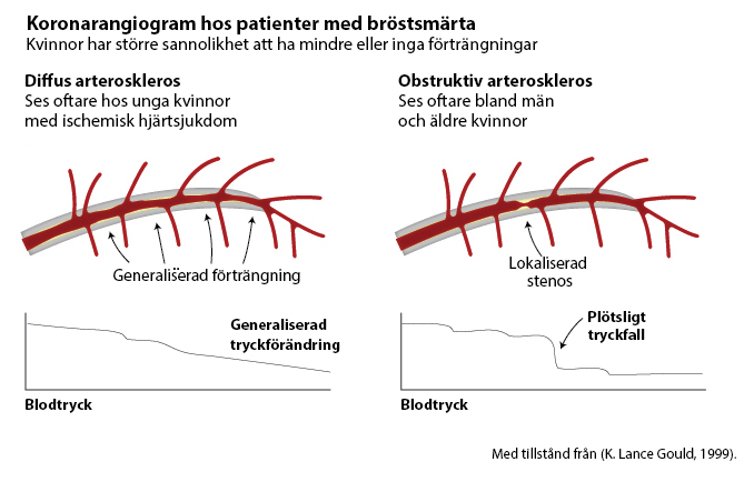 coronary Angiograms for pts with chest pain